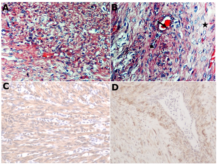 (A) Neoplasia intestinal, 40x H&E. (B) c&eacute;lulas pleom&oacute;rficas en &aacute;reas desmopl&aacute;sicas
(*), mezcladas con c&eacute;lulas alargadas con n&uacute;cleos grandes y oscuros (cabeza de
flecha) y un crecimiento infiltrativo (flecha), 40x
H&E. (C) C&eacute;lulas neopl&aacute;sicas agrupadas en haces. Actina del m&uacute;sculo liso:
tinci&oacute;n inmunohistoqu&iacute;mica de (A), 10x. (D) Vimentina: tinci&oacute;n inmunohistoqu&iacute;mica
de (B), 10x.