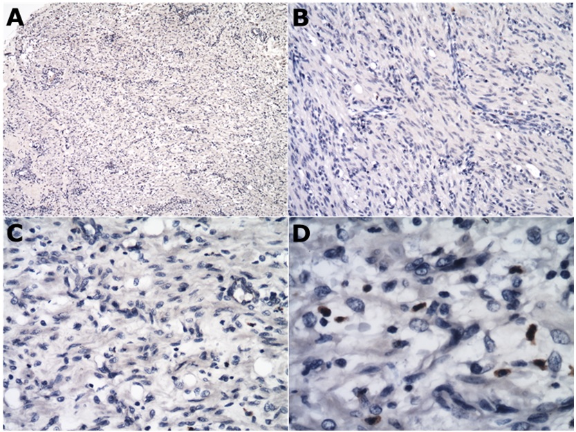  Immunohistochemical stain
for KIT (CD117), (A) Intestinal neoplasia, neoplastic cells were
negative for KIT (CD117) antigen. 4x. (B) Intestinal neoplasia, highly cellular spindle cell neoplasm composed
of fusiform cells arranged in streams and bundles, were negative for KIT, 10x.
(C) Immunohistochemistry staining of KIT (CD117) antigen, 20x and (D); 40x.