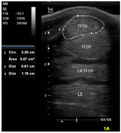 Ultrasonographic image of zone 1A of the palmar aspect of the metacarpus of a Colombian Creole equine (SDFT: superficial digital flexor tendon, DDFT: deep digital flexor tendon, AL: accessory ligament, SL: suspensory ligament).