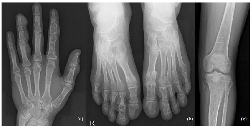a) Multiple enchondromas in the left hand, about 15 enchondroma foci in all phalanges in fingers I-IV and in metacarpal bones I-IV; b) multiple enchondromas in the foot, about 10 enchondroma foci in toes I-V and metatarsals; c) enchondroma in the proximal part of left tibia.