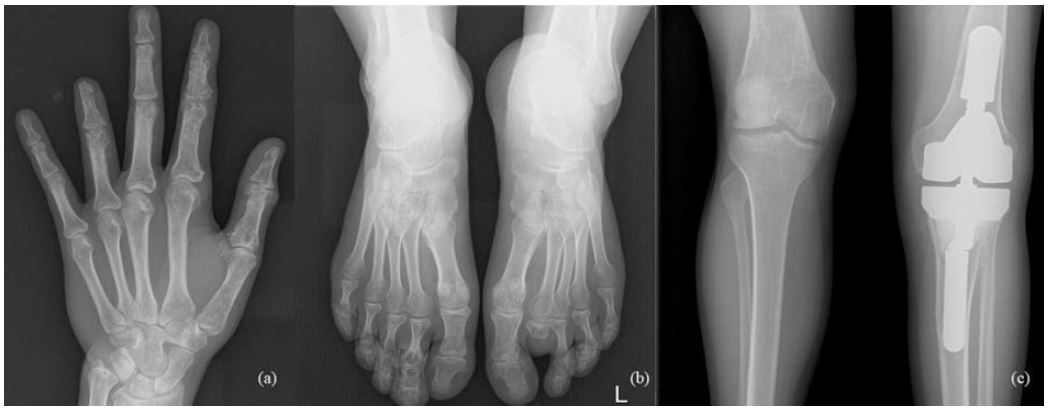a) 2020, after amputation of the distal phalanx of IV finger was performed, 13 left hand enchondroma curettages were performed, most of which were performed with cancellous bone grafting; b) 2020, after II toe amputation and 3 curettages with cancellous bone grafting; c) 2020, resection of the tumor recurrence and arthroplasty with a special prosthesis.