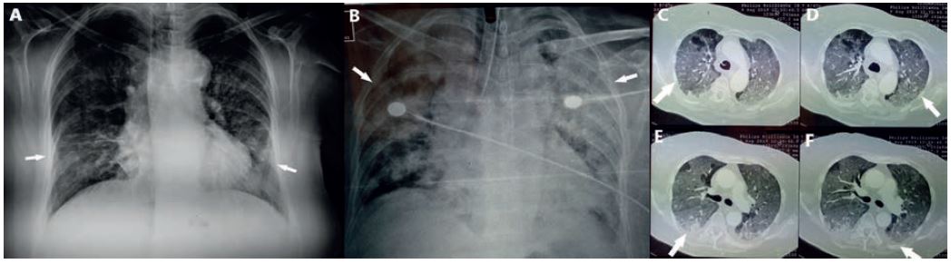 A: Chest X-ray shows patchy diffuse infiltrates in both lungs mostly in the left lower lobe on admission. B: Chest X-ray shows diffuse lung infiltrates after two days of hospitalization. C, D: Chest Computed Tomography reveals diffuse ground glass opacities. E, F: Chest Computed Tomography reveals pleural effusion in both lungs.