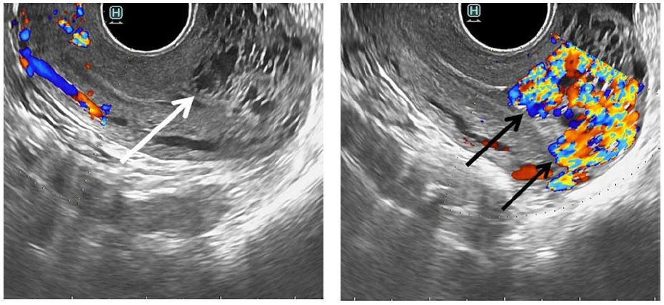 Transvaginal grayscale ultrasound image of the uterus in sagittal plane demonstrates tubular hypoechoic areas within myometrium (white arrow), while colour Doppler shows the lesion of vascular origin (black arrows)