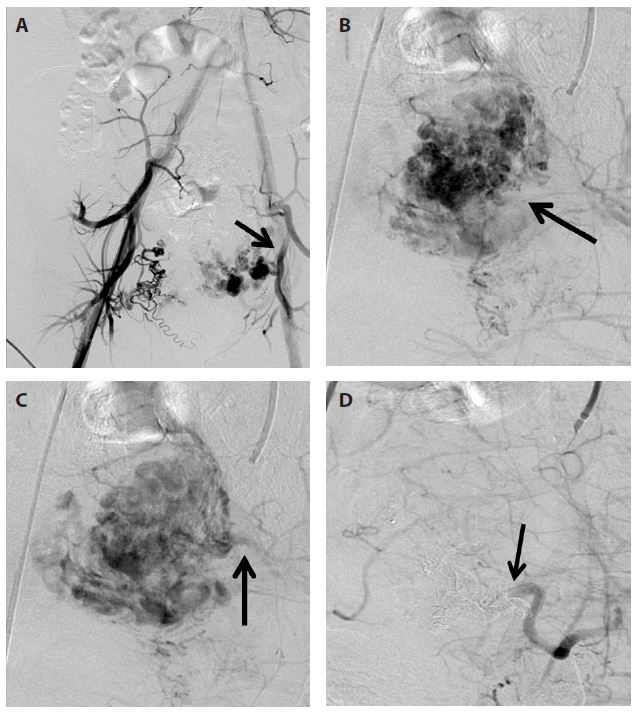 (A) Pelvic angiography demonstrates hypervascular structure arising from the left uterine artery (arrow). (B) Selective angiography of the left internal iliac artery indicates a uterine AVM (arrow). (C) Image of venous phase demonstrates early draining vein (arrow). (D) Post-embolisation angiography reveals total occlusion of the left uterine artery (arrow) and absence of the previous AVM