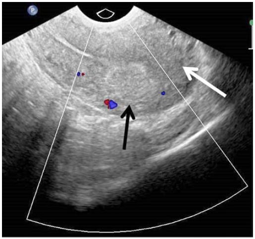 Transvaginal colour Doppler ultrasound image of the uterus in sagittal plane one month after embolisation demonstrates resolution of previous vascular lesion (white arrow), while hyperechoic mass within myometrium (black arrow) indicates embolic agent left post selective embolisation