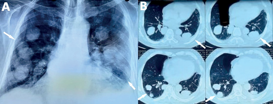 A Chest Xray shows pulmonary nodules in both lungs B Computed tomography of the chest reveals pulmonary nodules of various size and a small left pleural effusion