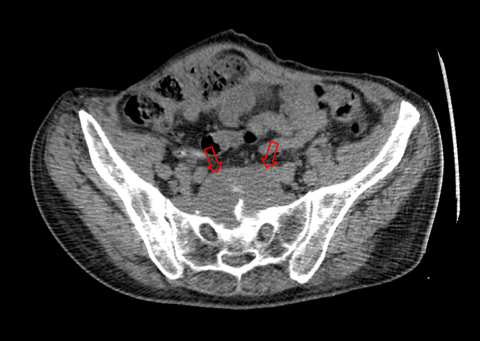Transverse CT image showing deep pelvic abscess located at presacral region before drainage (red arrows).