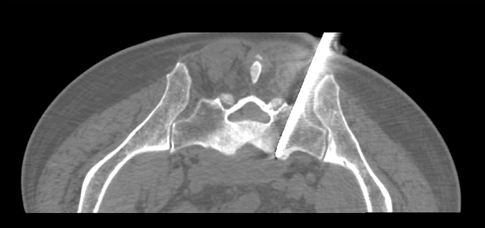 Transverse CT image showing bone marrow biopsy needle penetrating the sacrum.