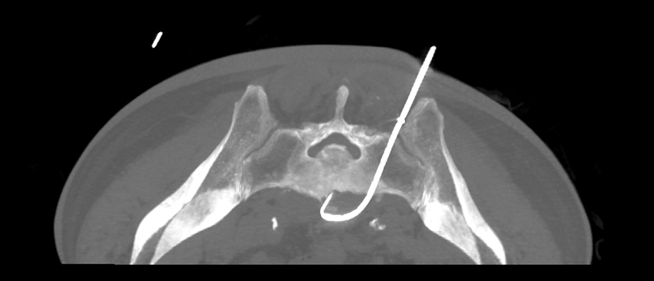 Transverse CT image showing drainage catheter placement.