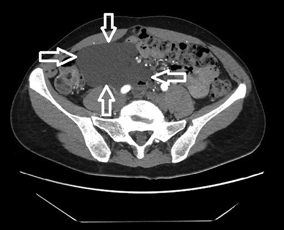CT scan of the lymphangioma (marked by open arrows) in right abdomen area. The mass is reaching the right side of abdomen wall, contacting abdominal aorta, vena cava and right common iliac artery, also ileocolic artery and vein.