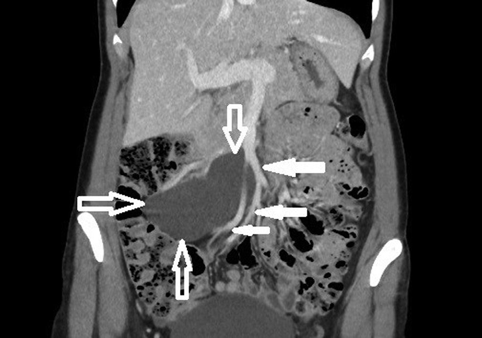 CT scan of the lymphangioma (open arrows) in right abdomen area. The mass extends from pancreatic head and superior mesenteric vein near ileum to right iliac area along the ileocolic artery and vein. Superior mesenteric vein and ileal veins are visible (bold arrows).