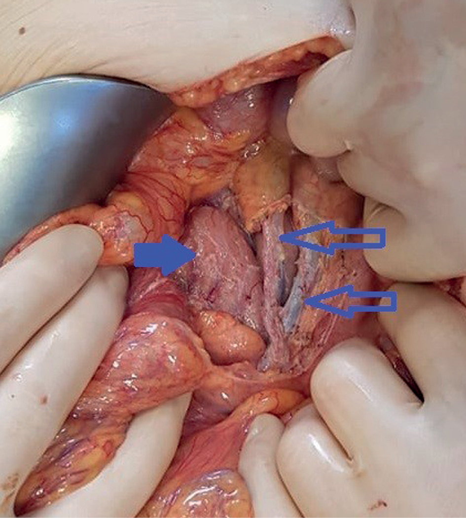 The picture shows the third portion of the duodenum (bold arrow) and the ileocolic and superior mesenteric vessels (open arrows) after the removal of lymphangioma.