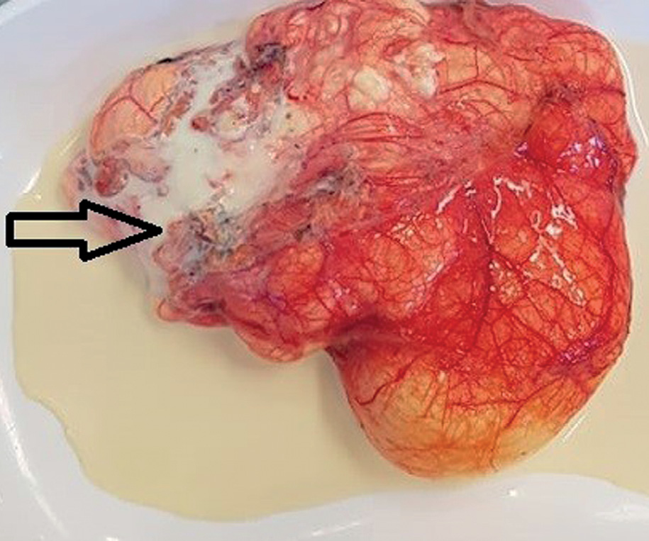 The picture shows milk-like fluid (open arrow) coming out of the lymphangioma. The fluid color is similar to milk due to the accumulation of lymphocytes.