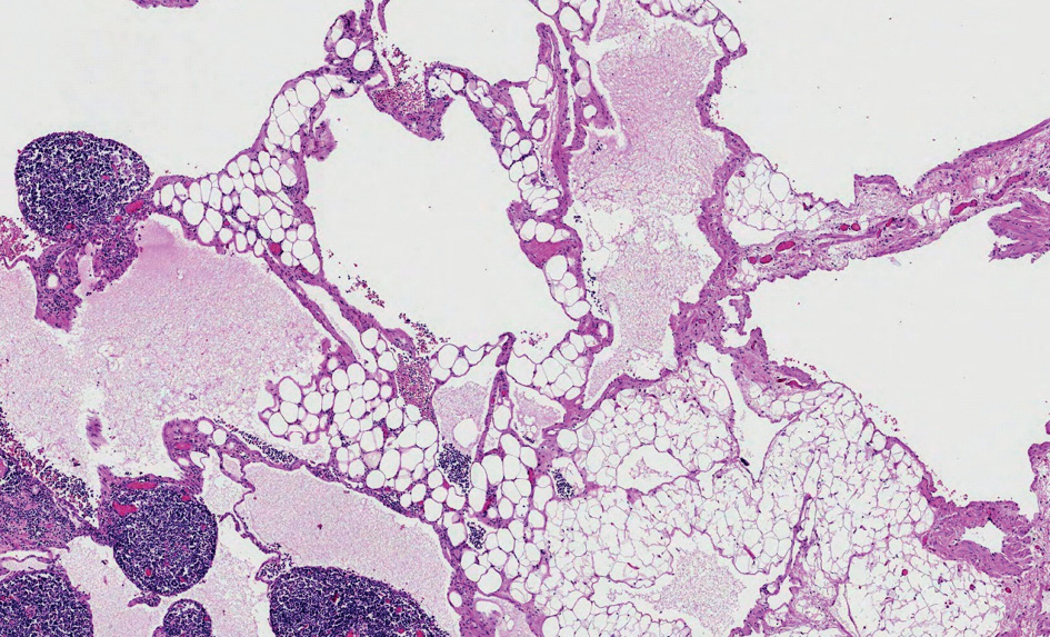 Cystic tumor structures with lymphoid aggregates. 40x magnification hematoxylin and eosin.