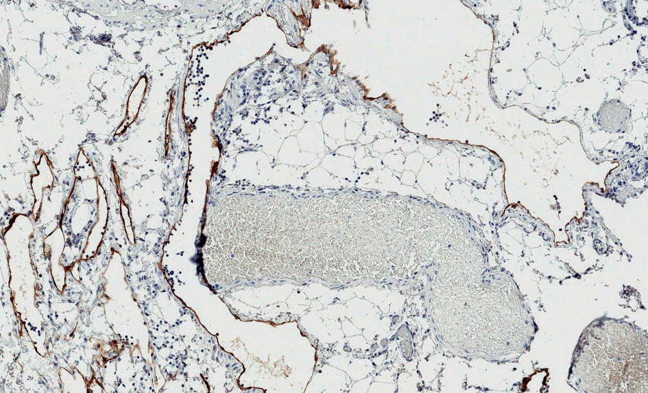 Lining of tumor structures positive for podoplanin (D2-40). 100x magnification.