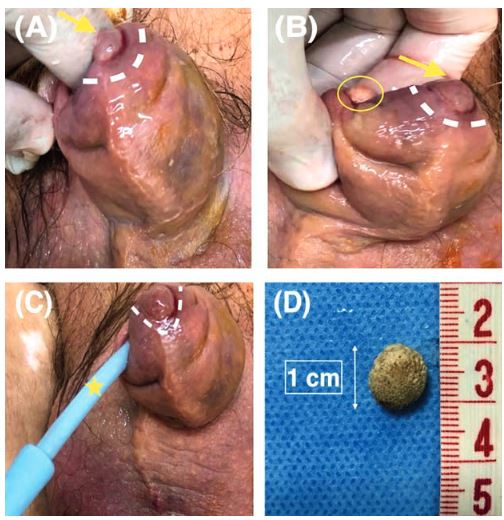 A Photo demonstrating the round partly ulcerative lesion yellow arrow white dotted line on the left side of the tip of the foreskin Note the thickened irritated and soaked prepuce B Photo demonstrating stone’s removal The index finger was inserted in the preputial sac through the phimotic ring yellow circle The skin lesion gradually receded following stone’s removal yellow arrow white dotted line C Urinary catheter insertion to relieve acute urinary retention yellow asterisk The round partly ulcerative lesion is also depicted white dotted line D The preputial stone measuring 1 cm in maximum diameter