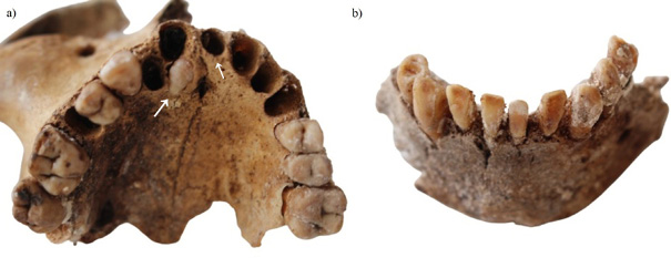 Details of dental pathologies: supernumerary teeth (a); severe anterior teeth wear (b).