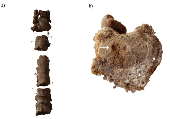 Two examples of spinal diseases including ankylosing spondylitis (a); and Schmorl&rsquo;s node defect (b).