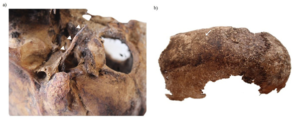Detail of a case of Eagle&rsquo;s syndrome (a); detail of a case of scaphocephaly (b).
