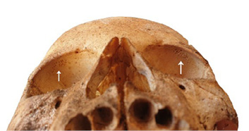 Detail of cribra orbitalia seen in the orbits of one subject.