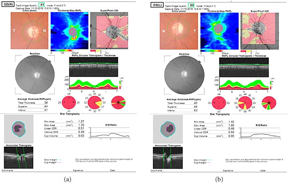 OCT shows thinning of retinal nerve fiber layer.
