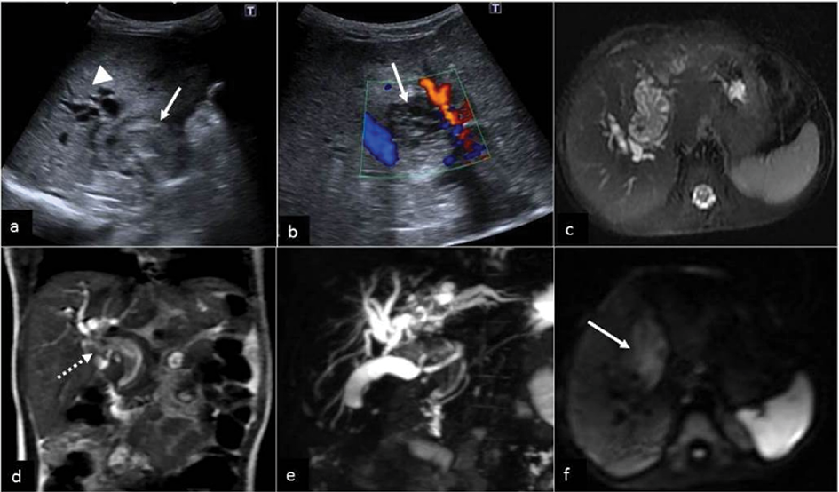 (a) US showing heteroechoic intraductal portal mass white arrow causing bilobar IHBRD arrowhead and (b) no definite blood flow within the mass on Colour Doppler (c) Coronal T2weighted magnetic resonance imaging illustrating a heterogenous predominantly hyperintense lobulatedshaped mass arising within the common bile duct white dashed arrow extending superiorly to the level of the porta (d) oronal magnetic resonance cholangiopancreatography shows large filling defect with dilated intrahepatic bile ducts (e) DWI b800smm2 image c shows mild restricted diffusion in mass white arrow