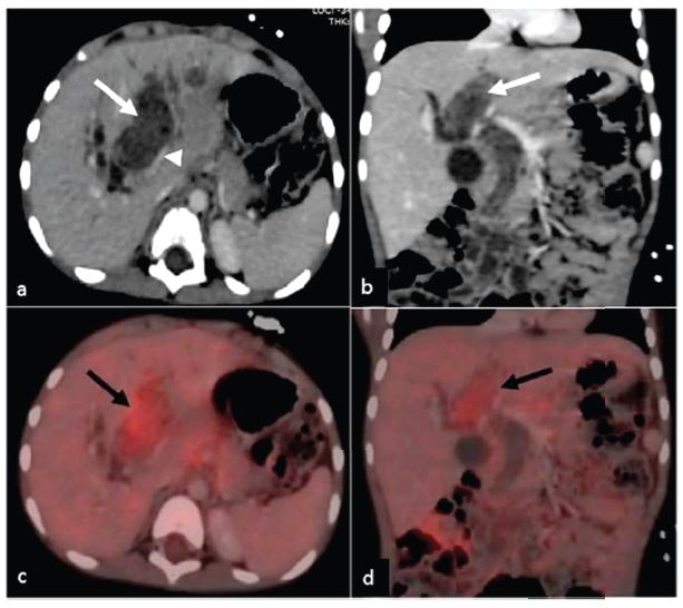 Post contrast computed tomography axial (a) and coronal (b) image demonstrating a mild enhancing heterogeneous mass within the common bile duct and left hepatic ductarrow causing compression of left portal vein seenarrowhead Axial (c) and coronal (d) PET CT showing mild metabolic activity within the soft tissue mass black arrow