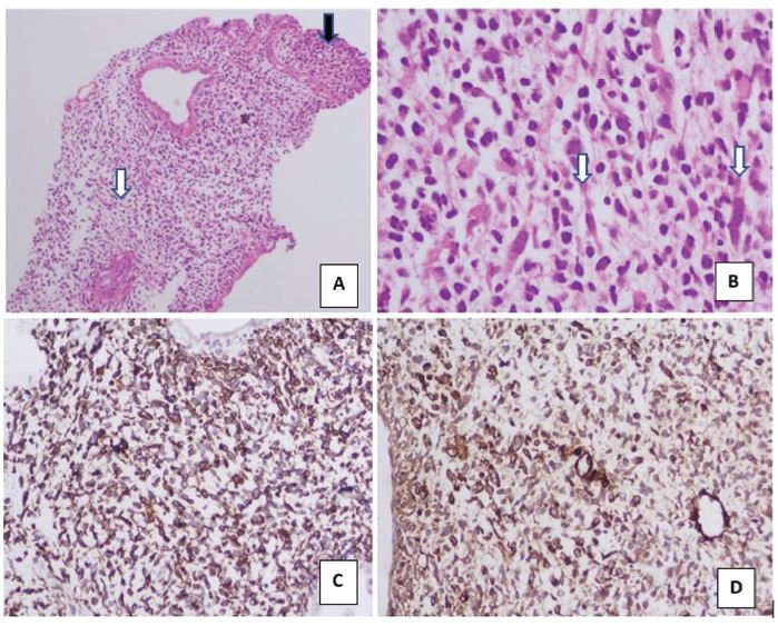Intraductal biopsy: Section shows a variably cellular tumour revealing. A) Hypocellular (white arrow) and hypercellular areas (Black arrow) with sheets of small rounded to spindle cells having inconspicuous nucleoli and scant cytoplasm. Hypocellular area reveals scattered tumour cells in a myxoid stroma &ndash; (Haematoxylin & Eosin, 4x). B) Few of the scattered tumour cells have abundant elongated eosinophilic cytoplasm (tadpole cells &ndash; white arrows). Dense condensation of tumour cells forming cambium layer was also seen (not shown). No significant anaplasia was seen in section examined &ndash; (Haematoxylin & Eosin, 40x). On immunohistochemistry, the tumour cells show C) positive for desmin (Desmin Immunohistochemistry, 10X) and D) positive for Smooth Muscle Actin (SMA) (SMA Immunohistochemistry, 10X)