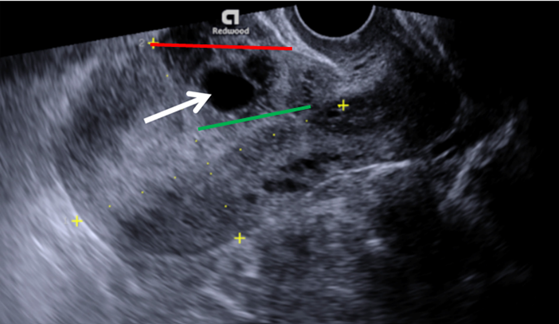 Transvaginal grayscale ultrasound image of the uterus in sagittal plane demonstrates gestational sac (arrow) implanted in the niche of previous caesarean scar site, crossing serosal line (red line), while uterine cavity line (green line) remains intact