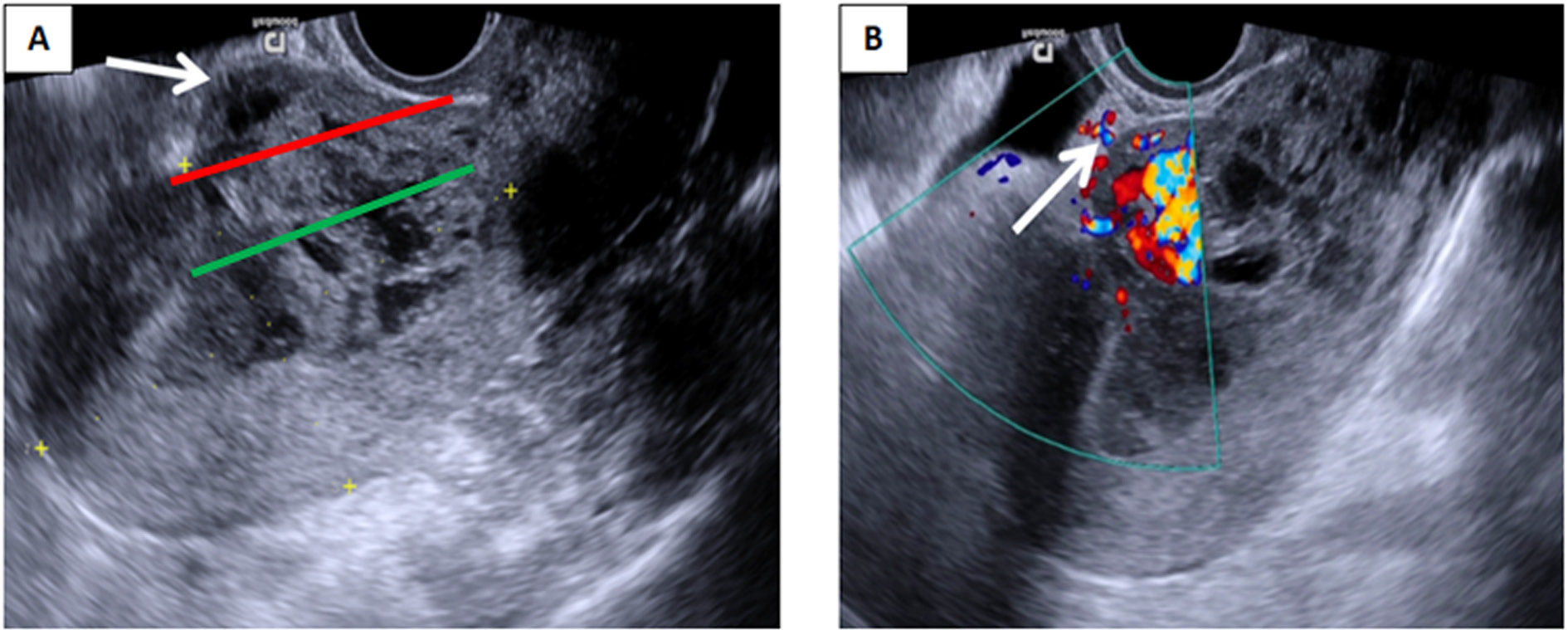 (A) Transvaginal grayscale ultrasound demonstrates heterogeneous mass inside the uterine cavity protruding anteriorly through the scar tissue (arrow). Both the serosal line (red line) and uterine cavity line (green line) are crossed. (B) Colour Doppler imaging reveals intense vascularity in the vesicouterine space (arrow), involving posterior wall of urinary bladder