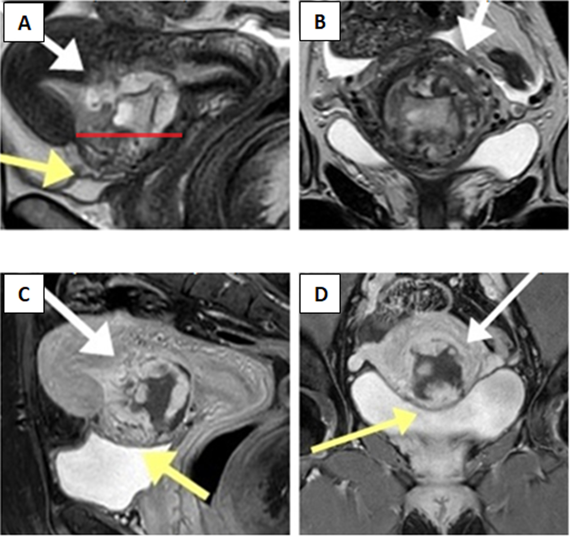 (A) Sagittal T2-weighted magnetic resonance image demonstrates gestational sac as heterogeneous mass in the anterior part of lower uterine wall within the prior caesarean scar site, extending into the uterine cavity (white arrow). The scar margins are separated (red line) following infiltration by ectopic tissue. The &ldquo;tenting sign&rsquo;&rsquo; (yellow arrow) suggests trophoblast invasion into the wall of urinary bladder. (B) Coronal T2-weighted sequence demonstrates the disruption of thin myometrium secondary to pathological infiltration (white arrows). (C, D) Sagittal and coronal T1-weighted delayed post-contrast magnetic resonance images with full urinary bladder show no &ldquo;tenting sign&rsquo;&rsquo; (yellow arrows) evident in A image, therefore transmural trophoblast growth into the urinary bladder can be excluded