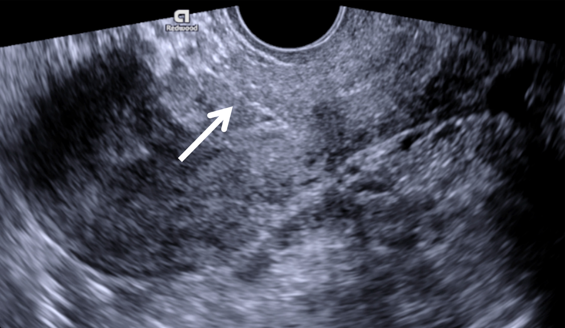 Transvaginal grayscale ultrasound image of the uterus in sagittal plane one month after the surgery demonstrates completely restored caesarean scar site (arrow)