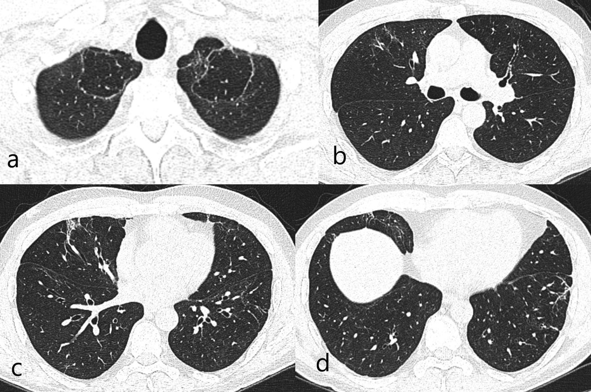 a Bilateral apical curvilinear reticular and central bullous changes b Linear reticular changes in the right middle lobemedial segment c Focal fibrosis areas accompanied with tubular bronchiectasis corresponding middle lobe medial segment inferior part on the right at the level of the inferior pulmonary vein d Reticular fibrotic changes in peripheral areas in the basal segments