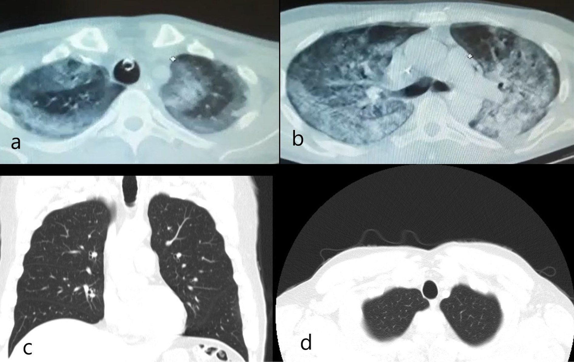 (a). The CT scan performed at the public hospital showed consolidation and GGO areas corresponding anatomically to the same location with apical reticular and bullous changes at the bilateral pulmonary apex. (b). Generalized consolidation and GGO were observed in the axial CT image from carina level. (c). Coronal and (d). Axial CT images before infection with COVID-19 showed that the pulmonary apices were clear.