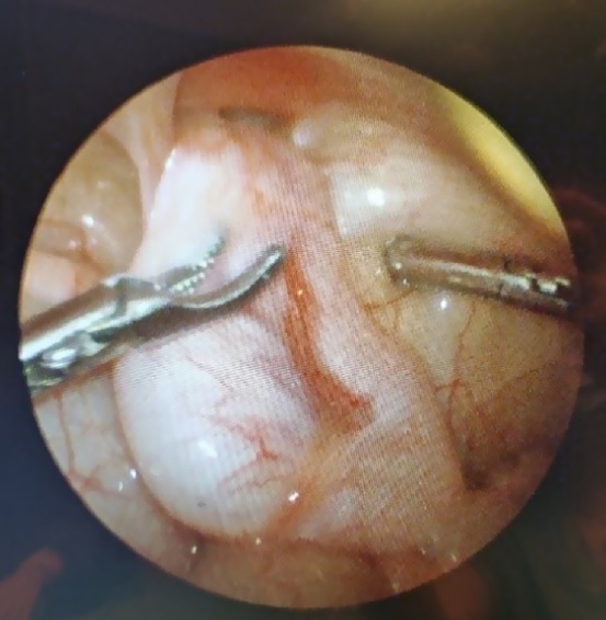 Laparascopic view of an intra-abdominal testis showing prior descent of the body and tail of the epididymi