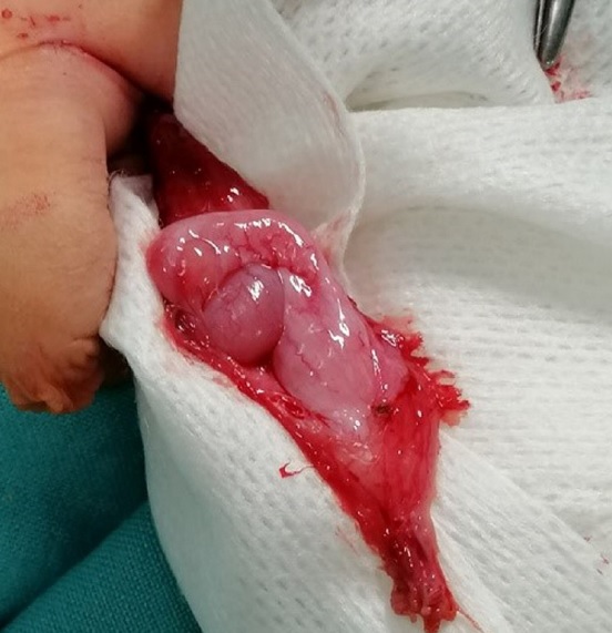 Prescrotal testis showing prior descent of the body and tail of the epididymis