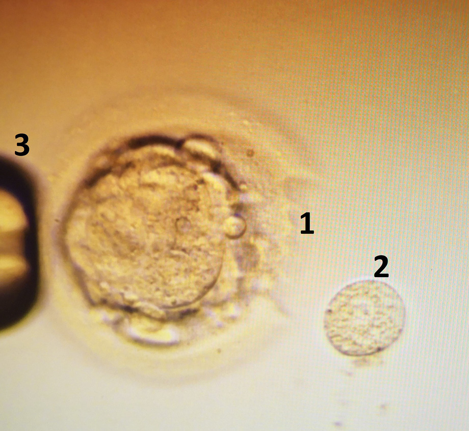 Laser assisted 4th day embryo (morula) biopsy. 1 – laser ablation of zona pellucida, 2 – biopsed single blastomere, 3 – holding pipette.