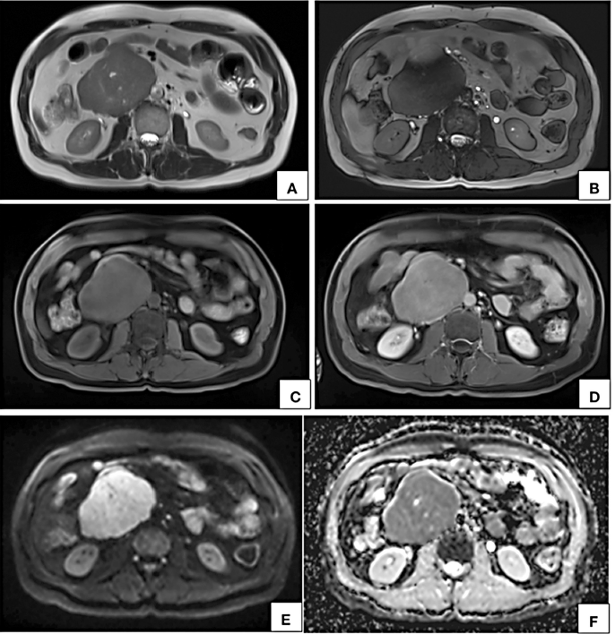 MRI axial T2W (A), T2W TRUFI (B), precontrast (C) and post contrast (D) T1W fat saturated VIBE images show a circumscribed lobulated retroperitoneal lesion on the right side of midline appearing hyperintense on T2W (A) and hypointense on T1W (C) showing near homogeneous contrast enhancement (D). In axial DWI (E) image and corresponding ADC map (F), the lesion shows restricted diffusion. Few T2W hyperintense nonenhancing cystic areas are seen within the lesion.