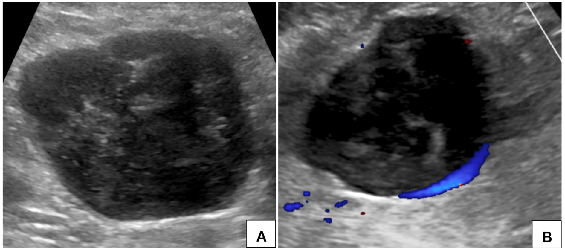 Ultrasonography of abdomen (A) with color Doppler flow imaging (B) shows a heterogeneously hypoechoic circumscribed lesion in the upper abdomen in right paramedian location with no significant internal vascularity.