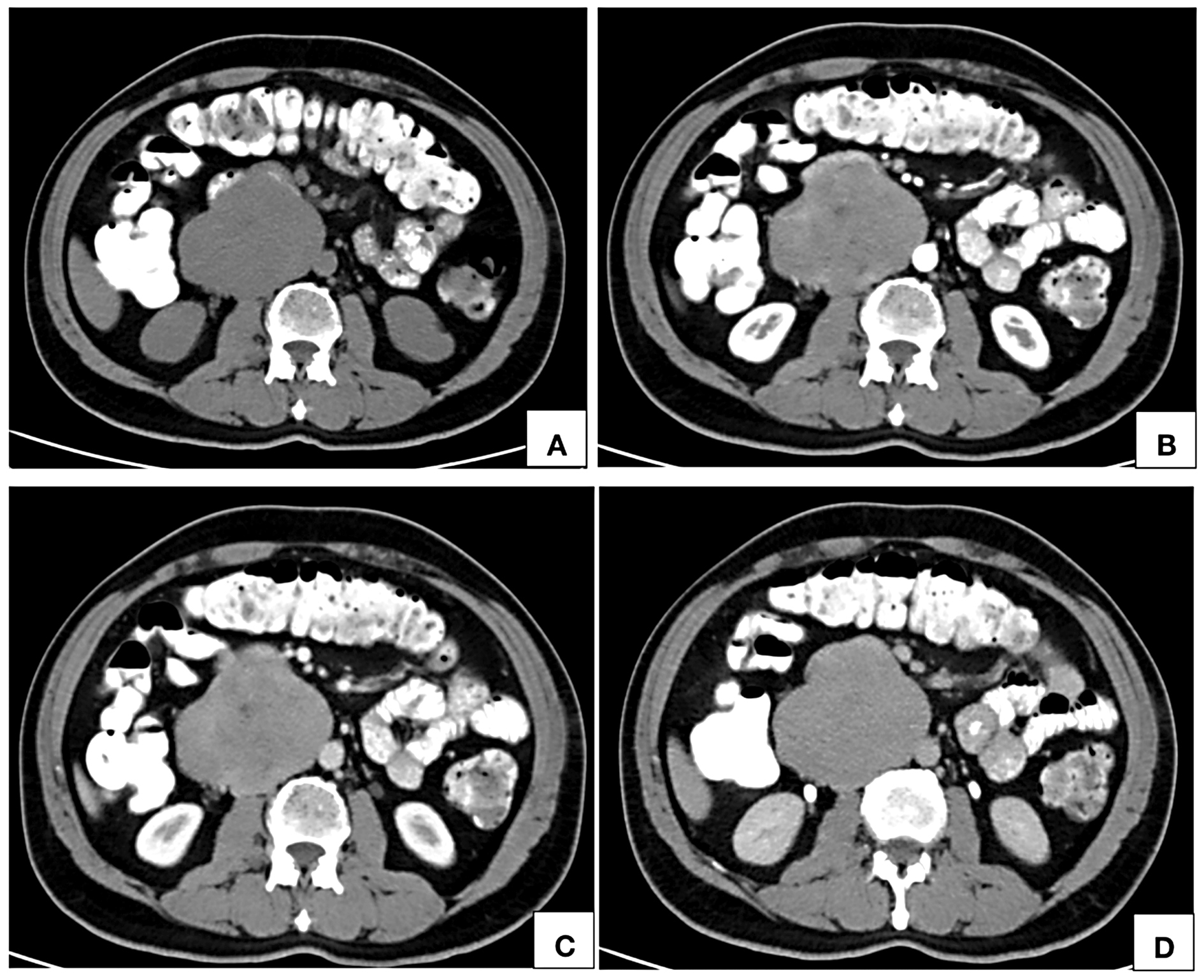 Computed tomographic axial images of noncontrast (A), arterial phase (B), portal venous phase (C) and delayed phase (D) show an isodense (A) retroperitoneal lesion right paramedian in location, in close contact with the abdominal aorta showing inhomogeneous areas of contrast uptake on arterial phase (B) with homogeneous enhancement on portal venous (C) and delayed phases (D). The lumen of inferior vena cava at the site of maximum contact is imperceptible.