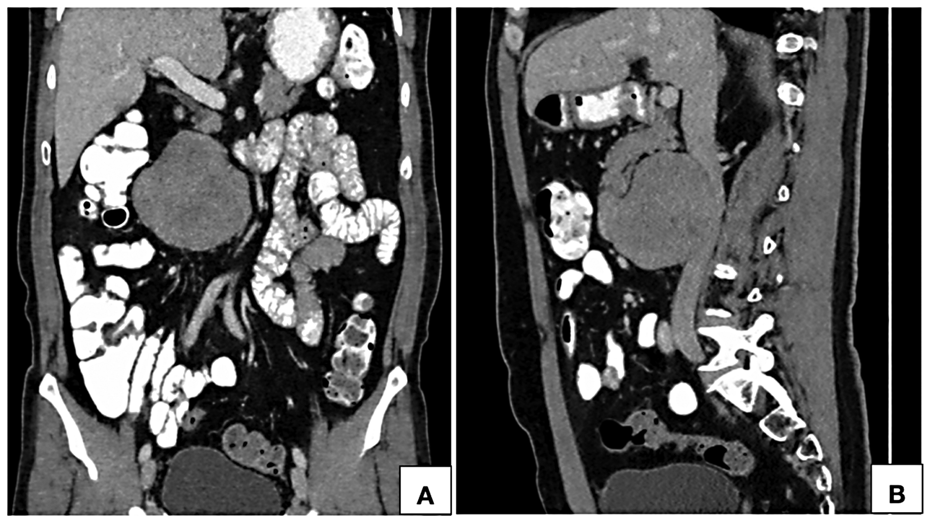Computed tomographic coronal (A) and sagittal (B) reformatted images in portal venous phase show a near homogeneously enhancing retroperitoneal lesion in anterior relation to the infrarenal inferior vena cava towards the right of the midline. Proximal and distal segments of the inferior vena cava show normal contrast opacification with no intraluminal component.
