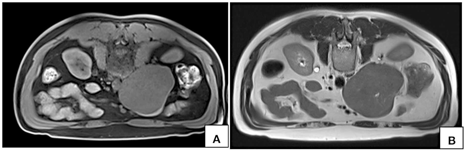 MRI axial T1W fat saturated VIBE (A) and T2W (B) images acquired in prone position show persistent nonvisualization of the lumen on inferior vena cava at the site of maximum contact.