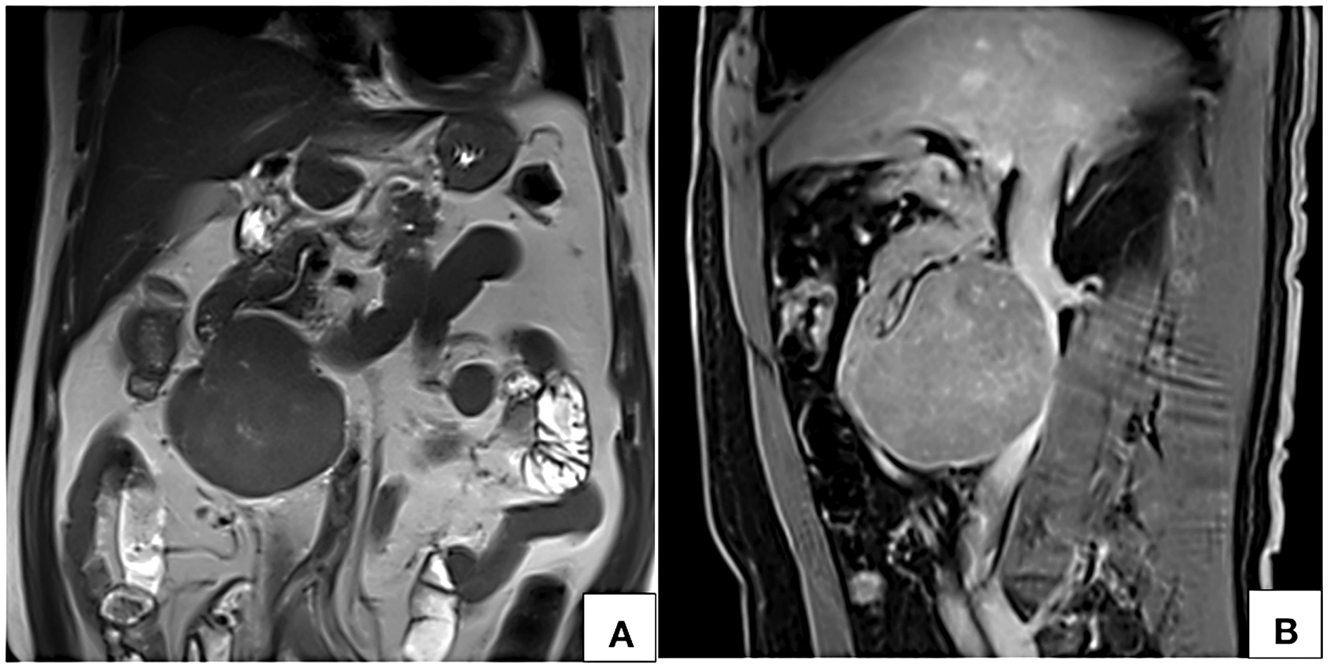 MRI coronal T2W (A) and sagittal post contrast T1W fat saturated VIBE (B) images show a circumscribed near homogeneously enhancing lesion along the anterior wall of infrarenal inferior vena cava with no intraluminal filling defect.