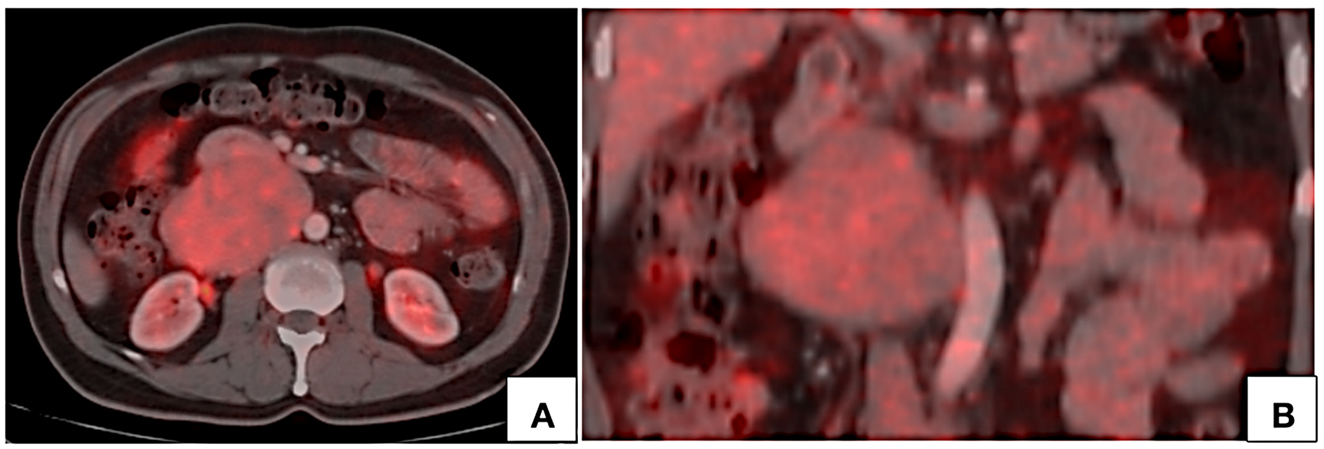 PET CT axial (A) and coronal (B) images show mild FDG uptake by the lesion with no hypermetabolic lymph nodes.