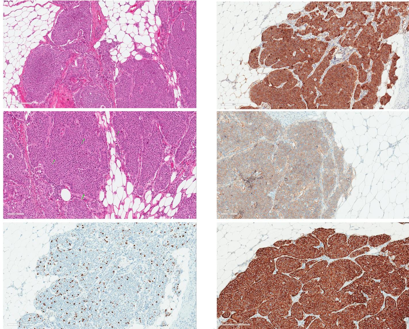 Microscopic examination of greater omentum metastatic lesions. (a) Alveolar structures of monomorphous round cells with centrally located nuclei and few polymorphous cells distributed randomly. (b) High mitotic ac- tivity with mitotic figures marked by green arrows. (c) Immunohistochemical Ki67 staining. The proliferative index in the metastatic lesion was up to 22% (quantified by digital pathological assessment with Aperio Nuclear V9). (d) Immunohistochemical Chromogranin A staining. The tumour mass shows diffuse cytoplasmic immunopositiv- ity. (e) Weak to moderate membranous staining with STTR5 immunohistochemical reaction. (f) Strongly positive diffuse immunohistochemical reaction for synaptophysin
