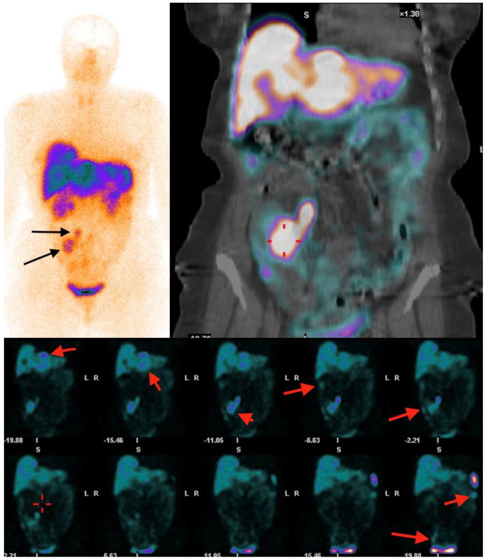 Top, a planar and SPECT/CT image of SSTR scintigraphy with 99mTc-tectrotyd presenting primary tumour with regional lymph node me- tastases. Bottom, abdominopelvic SPECT/CT images show multiple liver and peritoneal metastases (long arrows) with primary tumour (short arrow)