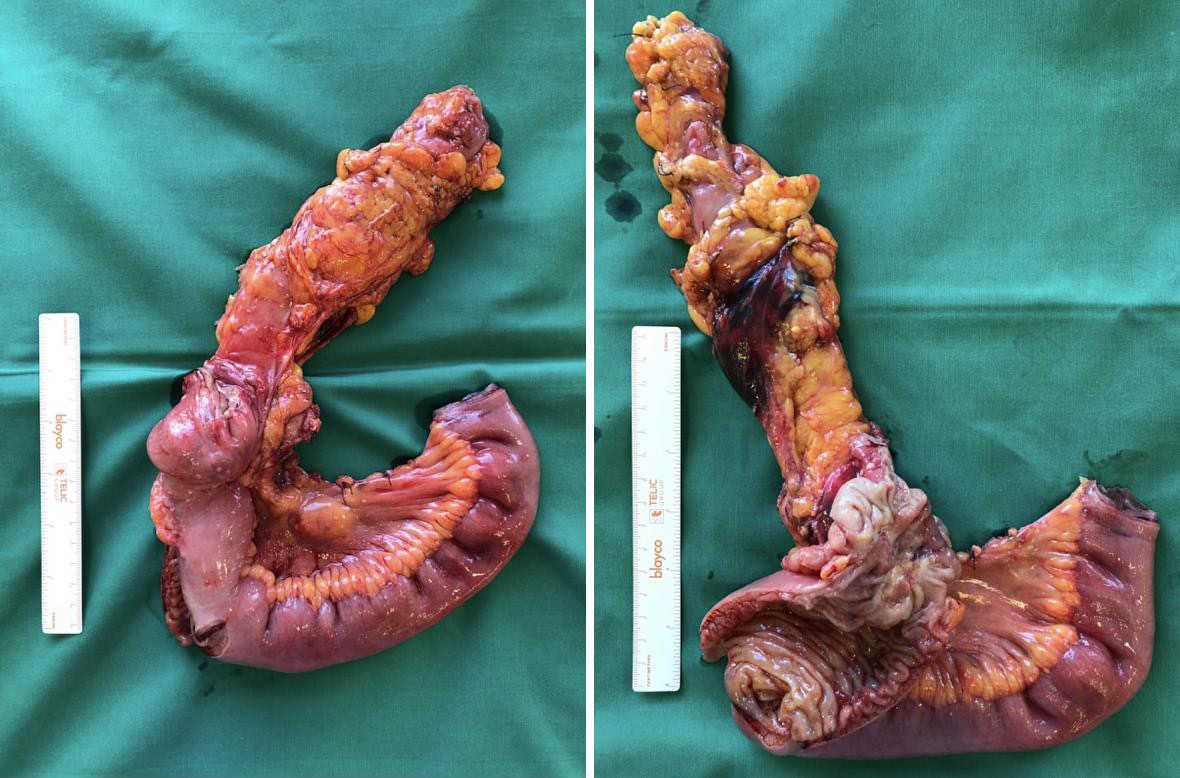 Gross total resection specimen after right hemicolectomy: a 4 � 4 � 7 cm mass of the cecum infiltrates all of the layers of the large intestine. The tumour extends towards the ascending colon and through the ileocecal valve to reach the distal ileum