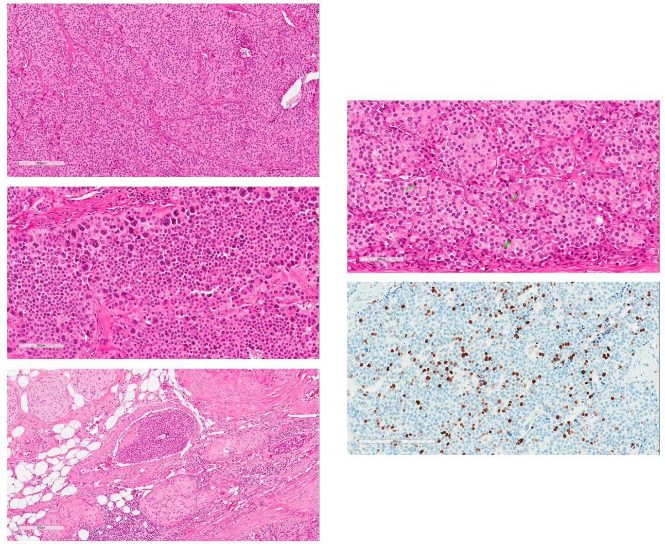 Microscopic examination of the tumour. (a) H & E section at low magnification. Tumour is composed of confluent islands of relatively monotonous cells with amphophilic granular cytoplasm and centrally located round nuclei. (b) Areas of marked cellular pleomorphism at higher magnification. (c) Evidence of intravascular spreading with tumour embolus in the vein lumen. (d) High mitotic activity with mitotic figures marked by green arrows. (e) Immunohistochemical staining by Ki-67. The proliferative index was up to 22% (quantified by digital pathological assessment with Aperio Nuclear V9)