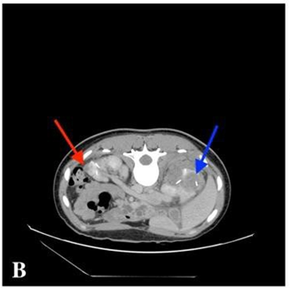 Post-cryo-CECT, fresh ablation zone (blue arrow) and the resorbed ablation zone (red arrow)