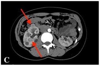 CECT scan: multiple tumours in the kidneys. The enlarging 18 mm tumour in the middle third of the right kidney; in addition, several new tumourous structures of up to 15 mm in both kidneys
